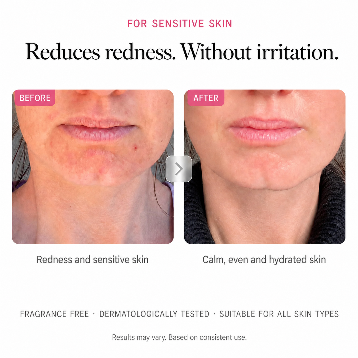 Arbutin 7% + Tranexamic Acid 4% Cream