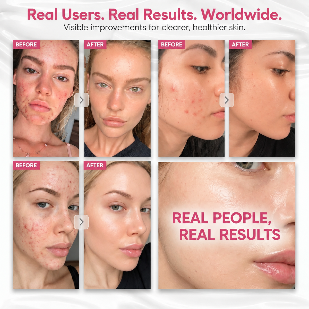 Arbutin 7% + Tranexamic Acid 4% Cream